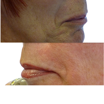 Semi permanent lip makeup for mature woman who'd lost the natural outline of her lips